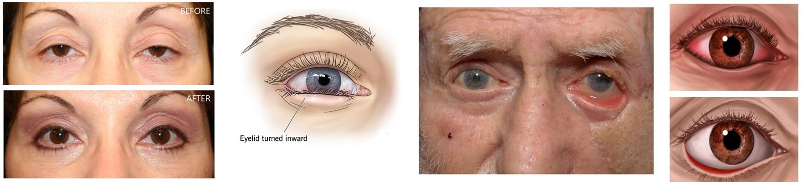Conditions Treated with Oculoplasty surgery and treatment